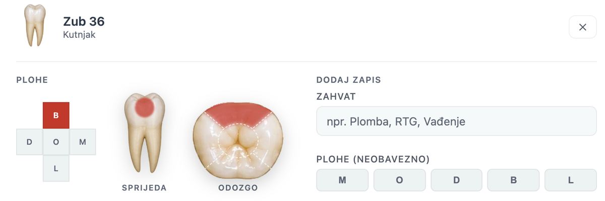 Prozor zuba 36 s plohama M, O, D, B i L, prikazom zuba sprijeda i odozgo te poljima za novi zapis zahvata